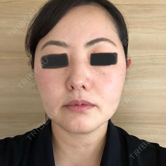 ハイフ（顔） オーキッド美容クリニック東京御徒町 DAY 27 メイン用