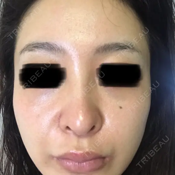 ピコレーザートーニング（美白・肝斑） ルラ美容クリニック 高田馬場院 DAY 7 メイン用