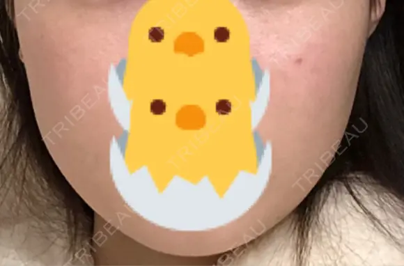 ボトックス（エラ・小顔） TCB東京中央美容外科 長野院 AFTER メイン用