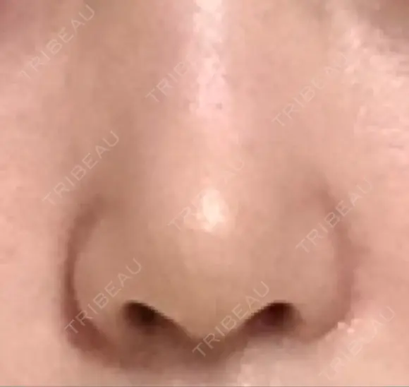 鼻尖形成（切開） / 軟骨移植 JUN CLINIC DAY 12 メイン用