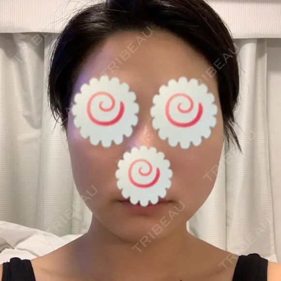 脂肪溶解注射（顔） 聖心美容クリニック 福岡院 DAY 1 メイン用