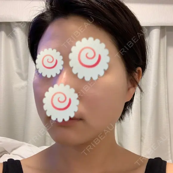 脂肪溶解注射（顔） 聖心美容クリニック 福岡院 DAY 1 メイン用