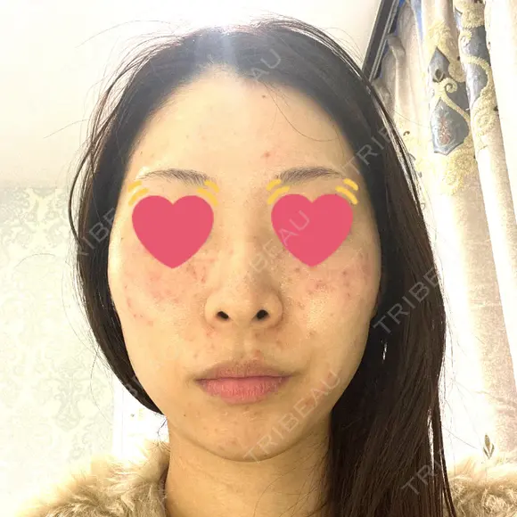 シミ取りレーザー フローラクリニック DAY 0 メイン用