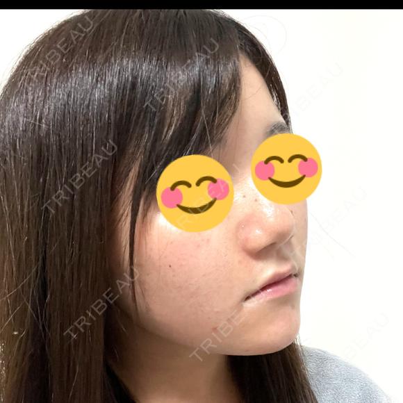ヒアルロン酸注入（鼻） / ボトックス（あご） / ヒアルロン酸注入（あご） プライベートスキンクリニック 梅田本院 DAY 2 メイン用