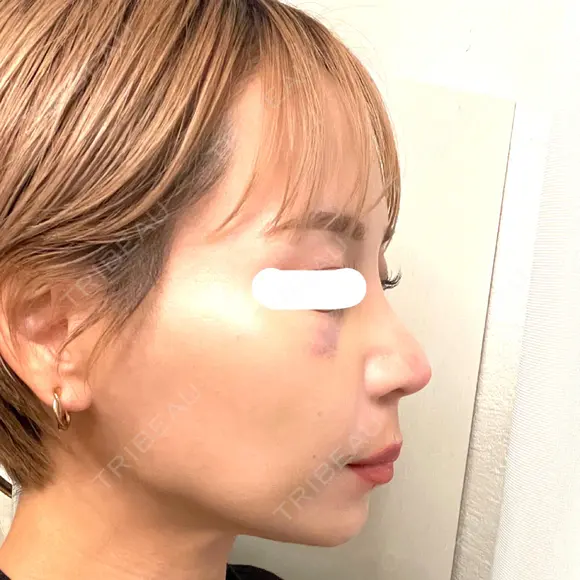 鼻尖形成（切開） / 鼻中隔延長（切開） / 軟骨移植 / 鼻翼基部形成（貴族手術） / 鼻柱下降・鼻唇角形成（猫手術） MAe Clinic 東京院 DAY 16 メイン用