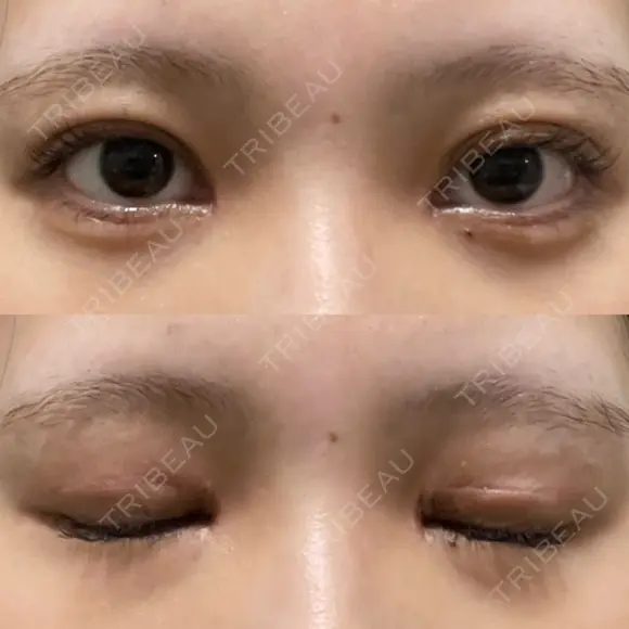 二重切開 / 目頭切開 / クマ治療 / 上まぶたの脂肪取り / 下まぶたの脂肪取り / タレ目形成・グラマラスライン（切開） BRIGHTS beauty clinic AFTER メイン用
