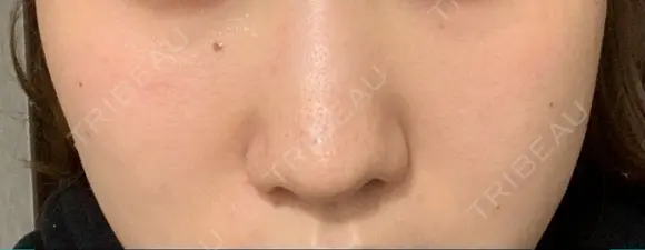 医療脱毛（顔） / 医療脱毛（うなじ） STARS CLINIC AFTER メイン用