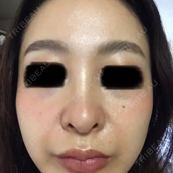 ピコレーザートーニング（美白・肝斑） ルラ美容クリニック 高田馬場院 AFTER メイン用
