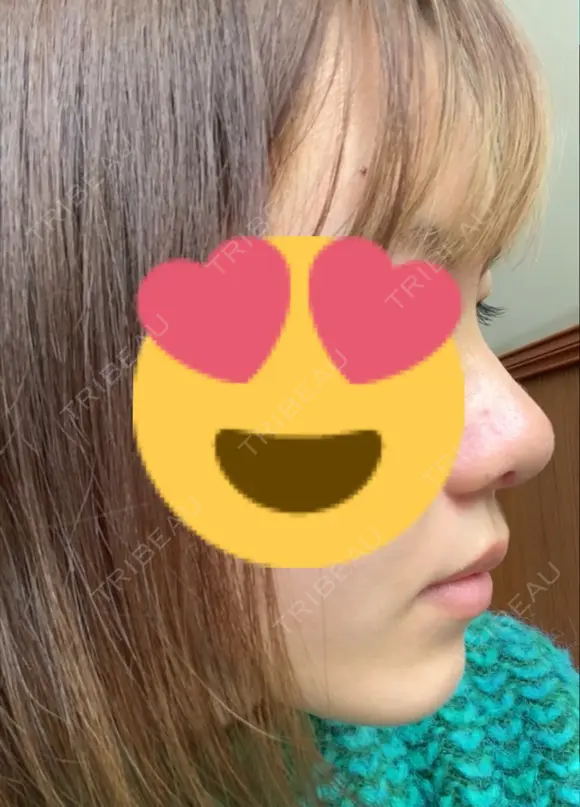 鼻中隔延長（切開） / 鼻尖縮小 ビスポーククリニック 福岡院 DAY 7 メイン用