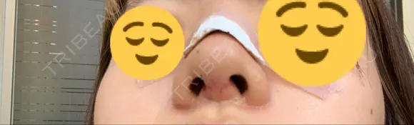 鼻中隔延長（切開） / 鼻尖縮小 ビスポーククリニック 福岡院 DAY 7 メイン用