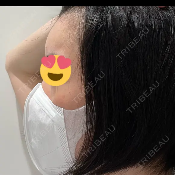 ヒアルロン酸注入（頬） BRIGHTS beauty clinic DAY 2 メイン用