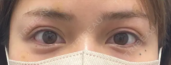 二重埋没 BELINDA CLINIC（ベリンダクリニック）新宿院 DAY 0 メイン用