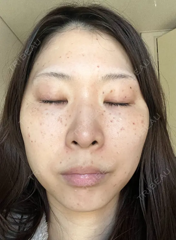 シミ取りレーザー フローラクリニック DAY 3 メイン用