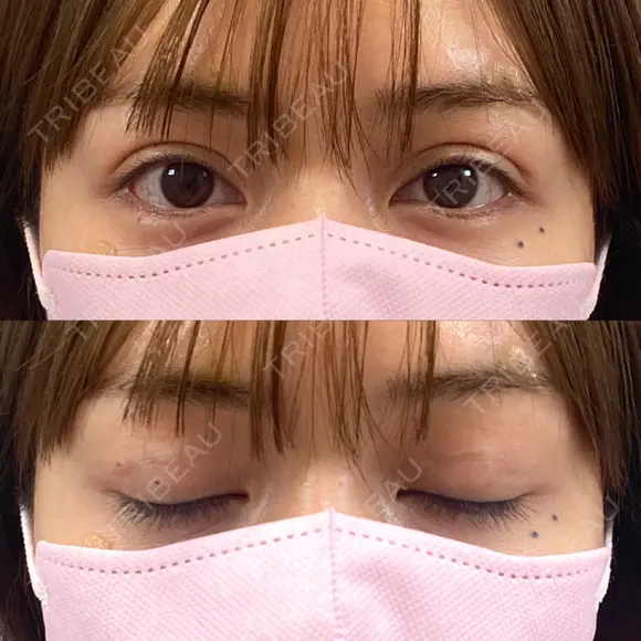 二重埋没 BELINDA CLINIC（ベリンダクリニック）新宿院 DAY 1 メイン用
