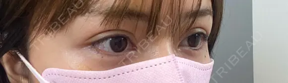 二重埋没 BELINDA CLINIC（ベリンダクリニック）新宿院 DAY 1 メイン用