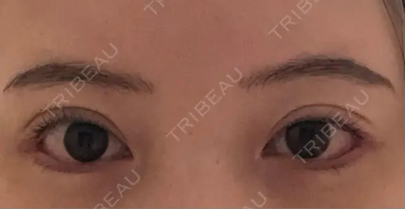 目尻切開 / タレ目形成・グラマラスライン（切開） JUN CLINIC AFTER メイン用