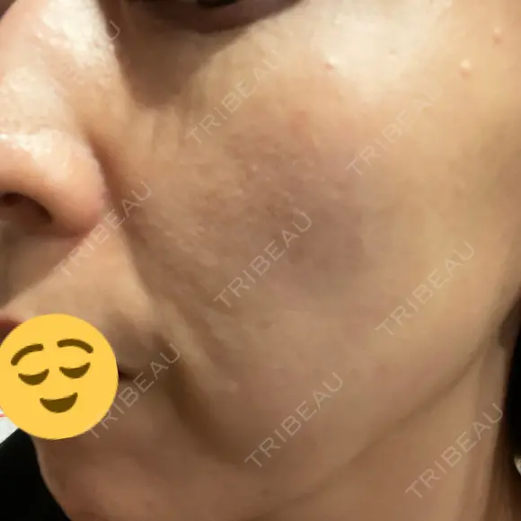 美肌レーザー / シミ取りレーザー あいちビューティークリニック AFTER メイン用