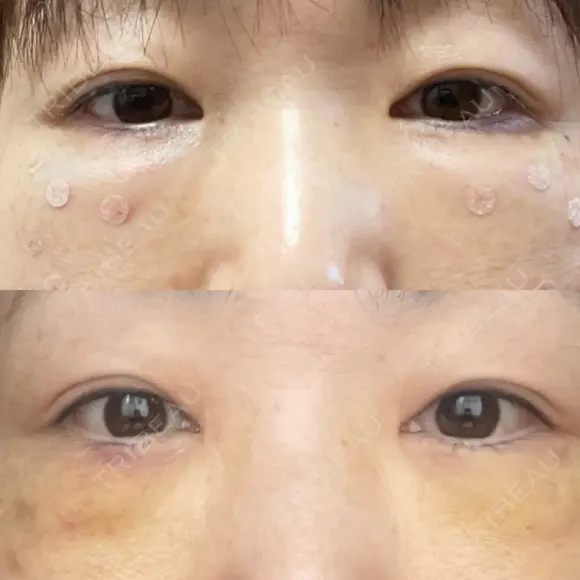 クマ治療 / 脂肪注入（肌） / ボトックス（あご） 銀座みゆき通り美容外科 大阪梅田院 DAY 7 メイン用