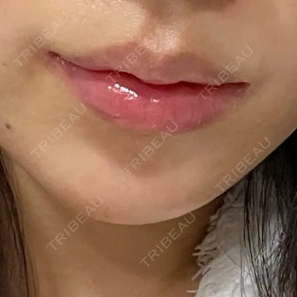 小鼻縮小（切開） / 口唇縮小術 / 口角挙上 / その他（鼻） / その他（口元） B-LINE CLINIC 池袋院 AFTER メイン用