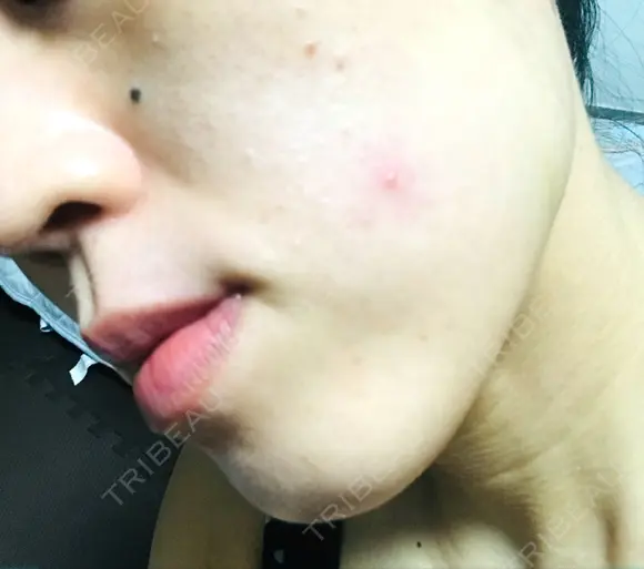 ボトックス（エラ・小顔） / ハイフ（顔） 美容皮膚科エルムクリニック 大阪院 DAY 8 メイン用