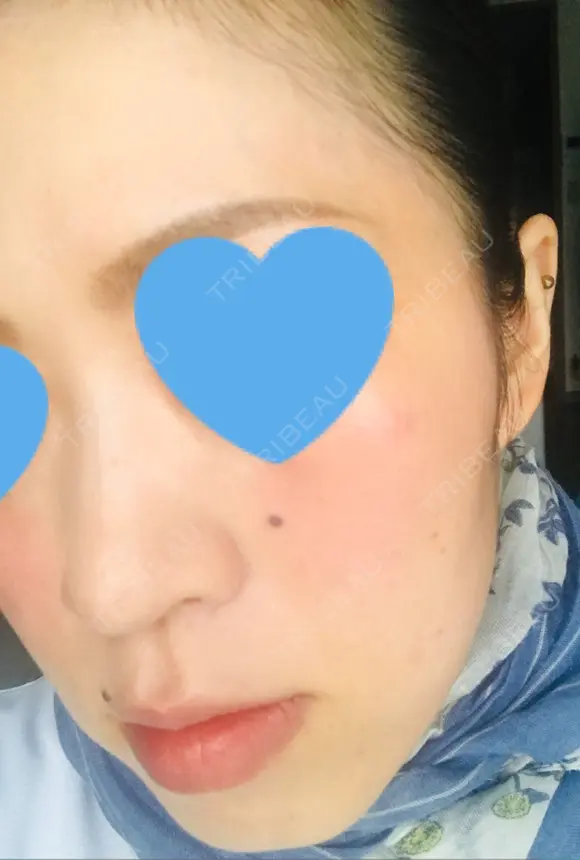 ボトックス（エラ・小顔） / ハイフ（顔） 美容皮膚科エルムクリニック 大阪院 AFTER メイン用