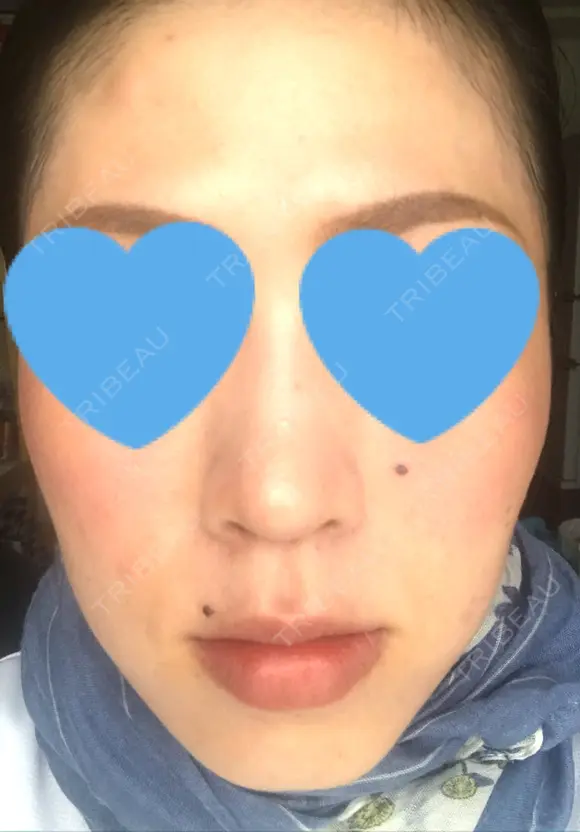 ボトックス（エラ・小顔） / ハイフ（顔） 美容皮膚科エルムクリニック 大阪院 DAY 11 メイン用