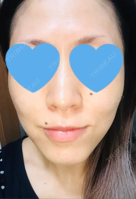 ボトックス（エラ・小顔） / ハイフ（顔） 美容皮膚科エルムクリニック 大阪院 DAY 9 メイン用