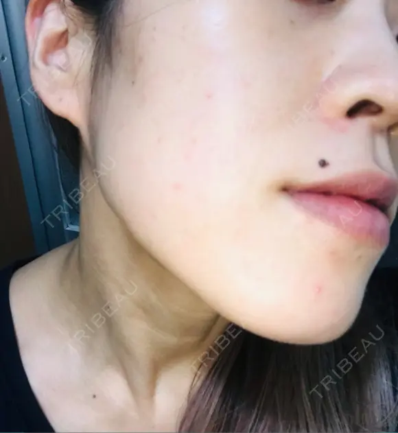 ボトックス（エラ・小顔） / ハイフ（顔） 美容皮膚科エルムクリニック 大阪院 DAY 9 メイン用