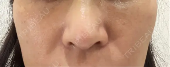 隆鼻術 / 鼻中隔延長（切開） / タレ目形成・グラマラスライン（切開） / 軟骨移植 / 脂肪注入（額） リッツ美容外科 東京院 AFTER メイン用