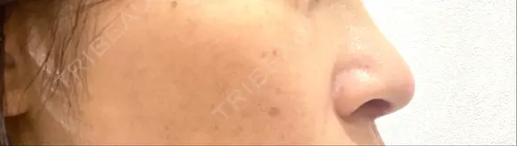 隆鼻術 / 鼻中隔延長（切開） / タレ目形成・グラマラスライン（切開） / 軟骨移植 / 脂肪注入（額） リッツ美容外科 東京院 DAY 9 メイン用