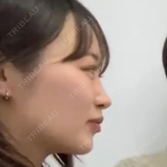 目頭切開 / タレ目形成・グラマラスライン（切開） / 口角挙上 / ボトックス（あご） / その他（口元） 東京形成美容外科 船橋院 DAY 237 メイン用