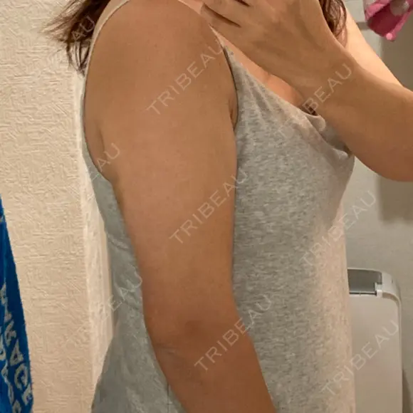 脂肪溶解注射（二の腕） 石倉クリニック 水戸院 DAY 3 メイン用