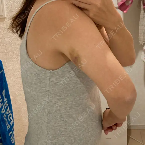 脂肪溶解注射（二の腕） 石倉クリニック 水戸院 DAY 3 メイン用