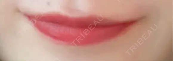 口角挙上 くさのたろうクリニック AFTER メイン用