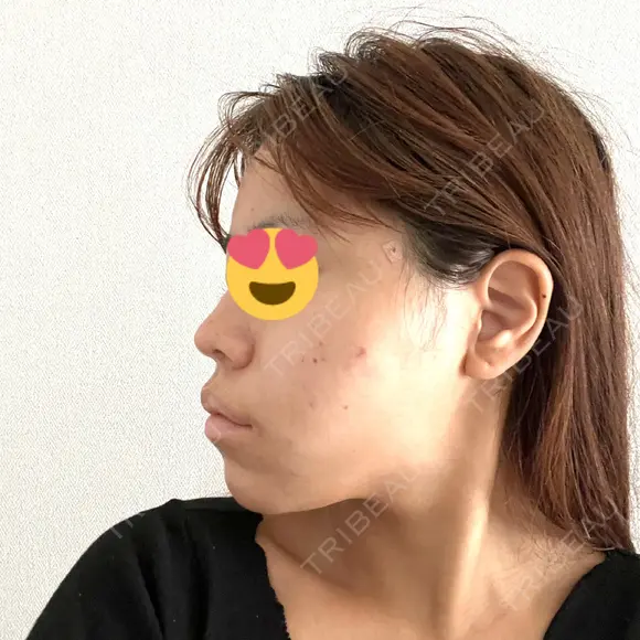 糸リフト TCB東京中央美容外科 池袋駅前院 DAY 33 メイン用