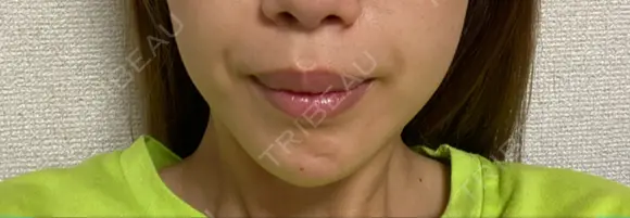 あごプロテーゼ エースクリニック 名古屋院 AFTER メイン用