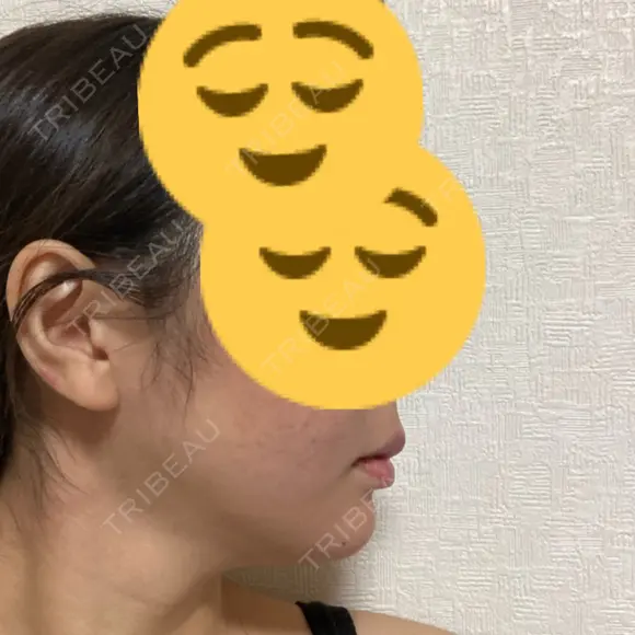 ヒアルロン酸注入（あご） レナトゥスクリニック 東京田町院 DAY 2 メイン用