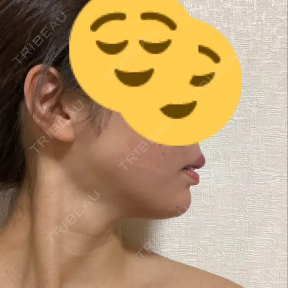 ヒアルロン酸注入（あご） レナトゥスクリニック 東京田町院 DAY 4 メイン用