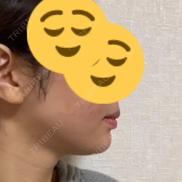 ヒアルロン酸注入（あご） レナトゥスクリニック 東京田町院 DAY 7 メイン用