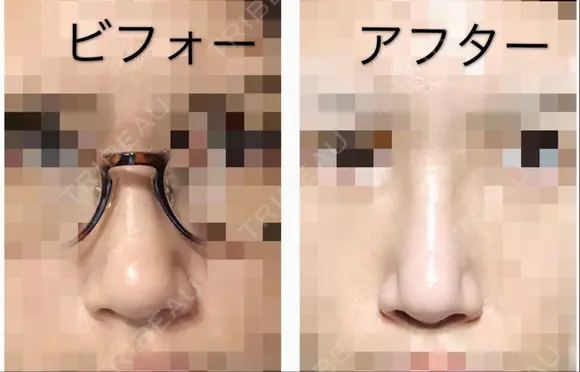 隆鼻術 / 鼻尖形成（切開） / 眉間プロテーゼ サラ美容外科 DAY 30 メイン用