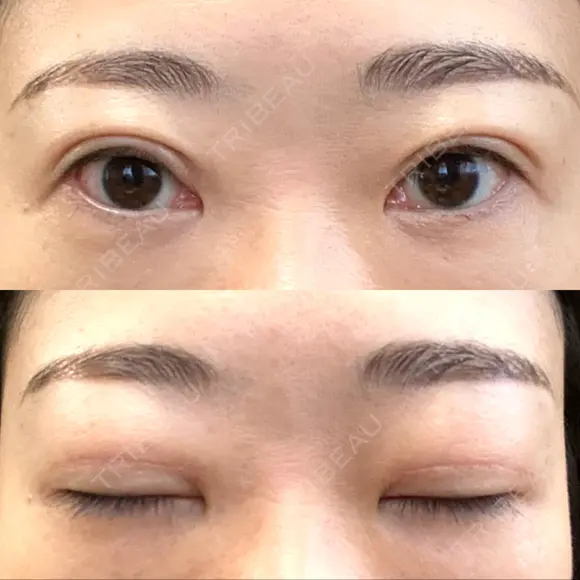 二重切開 / 上まぶたたるみ取り / PRP皮膚再生療法 BRIGHTS beauty clinic DAY 83 メイン用