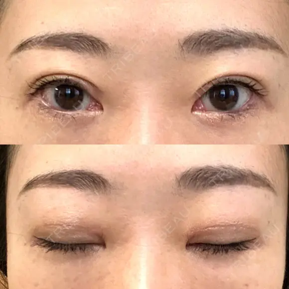 二重切開 / 上まぶたたるみ取り / PRP皮膚再生療法 BRIGHTS beauty clinic DAY 85 メイン用