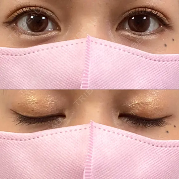 二重埋没 BELINDA CLINIC（ベリンダクリニック）新宿院 AFTER メイン用