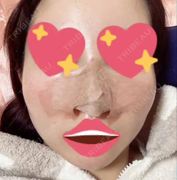 隆鼻術 / 軟骨移植 フェアクリニック川口 DAY 1 メイン用