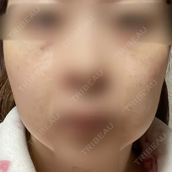 ヴェルヴェットスキン アリエル美容クリニック 大宮院 DAY 43 メイン用