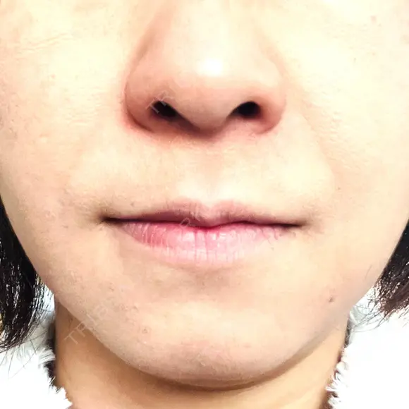 PRP皮膚再生療法 聖心美容クリニック 札幌院 DAY 13 メイン用