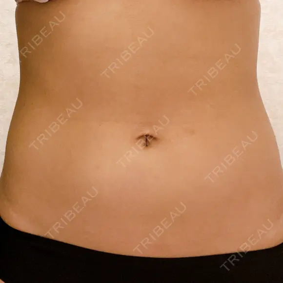 脂肪冷却（お腹） AI Beauty Clinic （エーアイ美容クリニック） DAY 1 メイン用