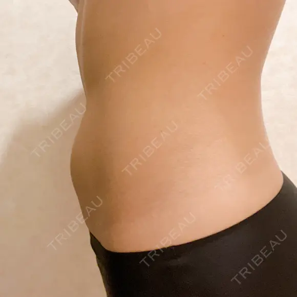 脂肪冷却（お腹） AI Beauty Clinic （エーアイ美容クリニック） DAY 1 メイン用