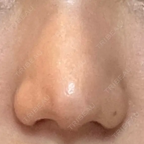 小鼻縮小（切開） GLANZ CLINIC AFTER メイン用