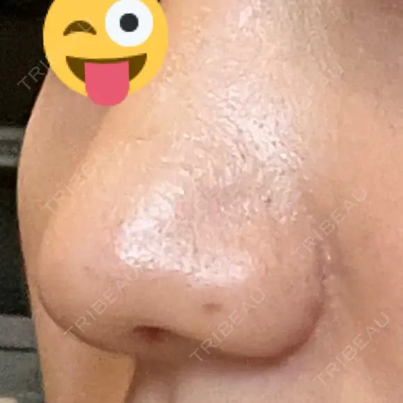 小鼻縮小（切開） GLANZ CLINIC DAY 30 メイン用